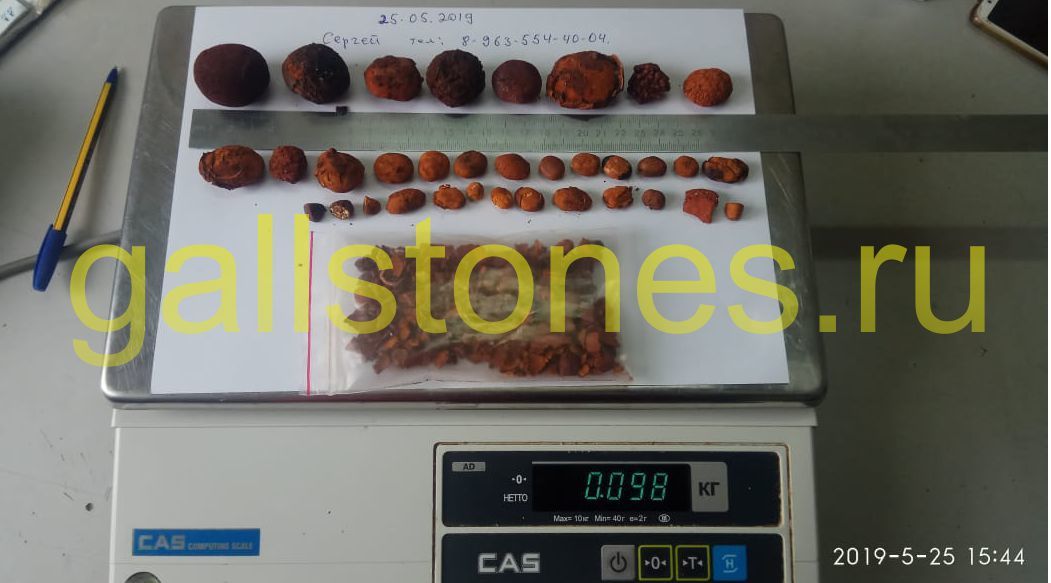 gallstones.ru gallstones.ru